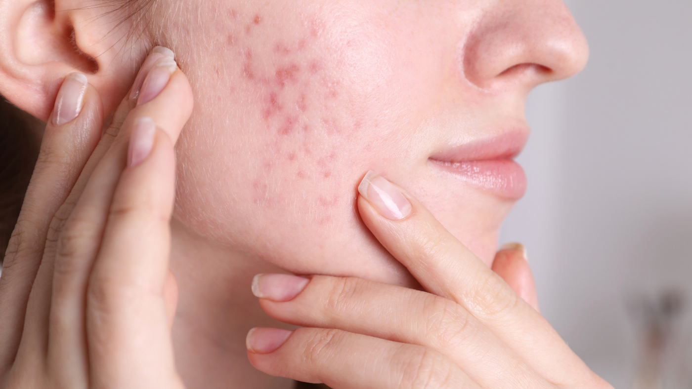 Close-up of a woman's acne-prone skin being examined, highlighting the use of Korean Skincare for Acne-Prone Skin: Clearer Skin with K-Beauty.